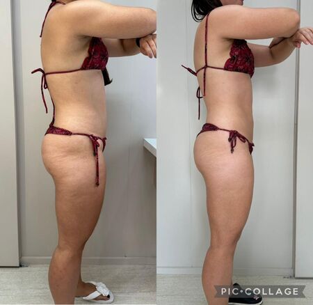 Resultado drenagem vibratória lateral direita - Dra. Anna Abreu